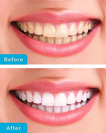 WhiteBite Pro Teeth Whitening Kit Sparkly Teeth